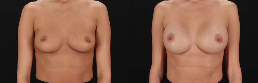 Breast Augmentation with Implant Before and After Photo by Baylan Plastic Surgery in Houston, TX