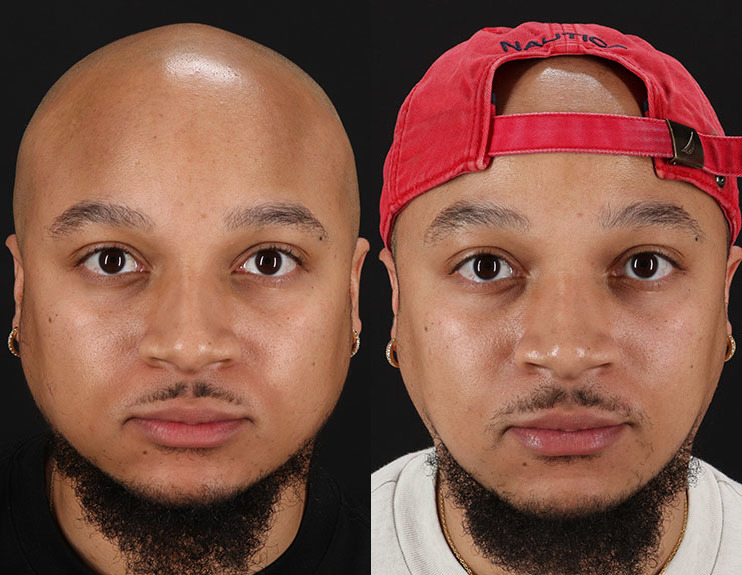 Botox Before and After Photo by Baylan Plastic Surgery in Houston, TX