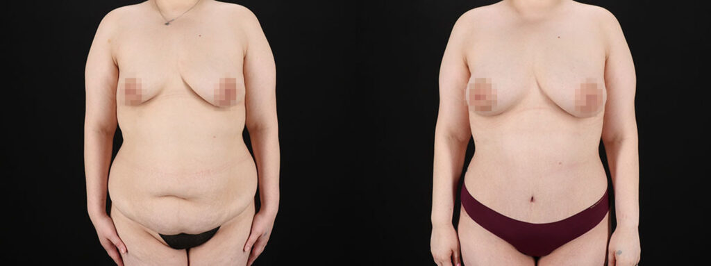 Abdominoplasty Before and After Photo by Baylan Plastic Surgery in Houston, TX