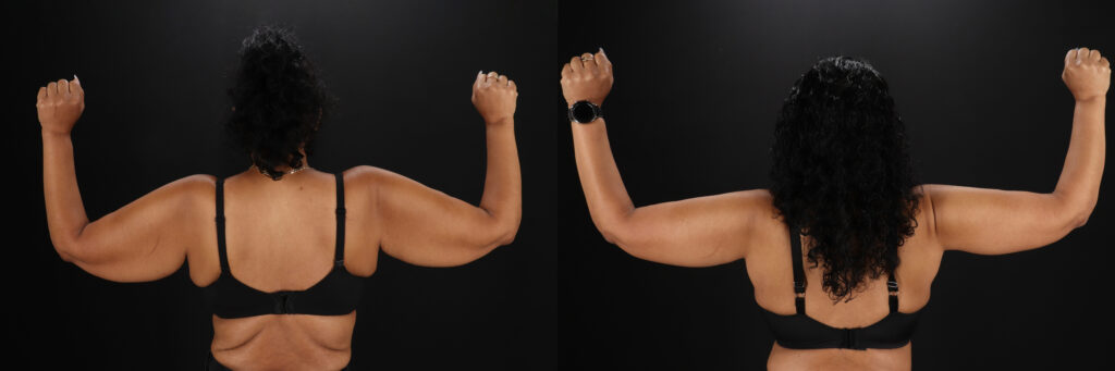 Brachioplasty, Liposuction before and after photo by Baylan Plastic Surgery in Houston, TX