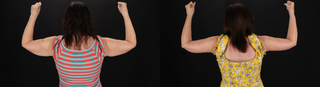 Brachioplasty, Liposuction before and after photo by Baylan Plastic Surgery in Houston, TX