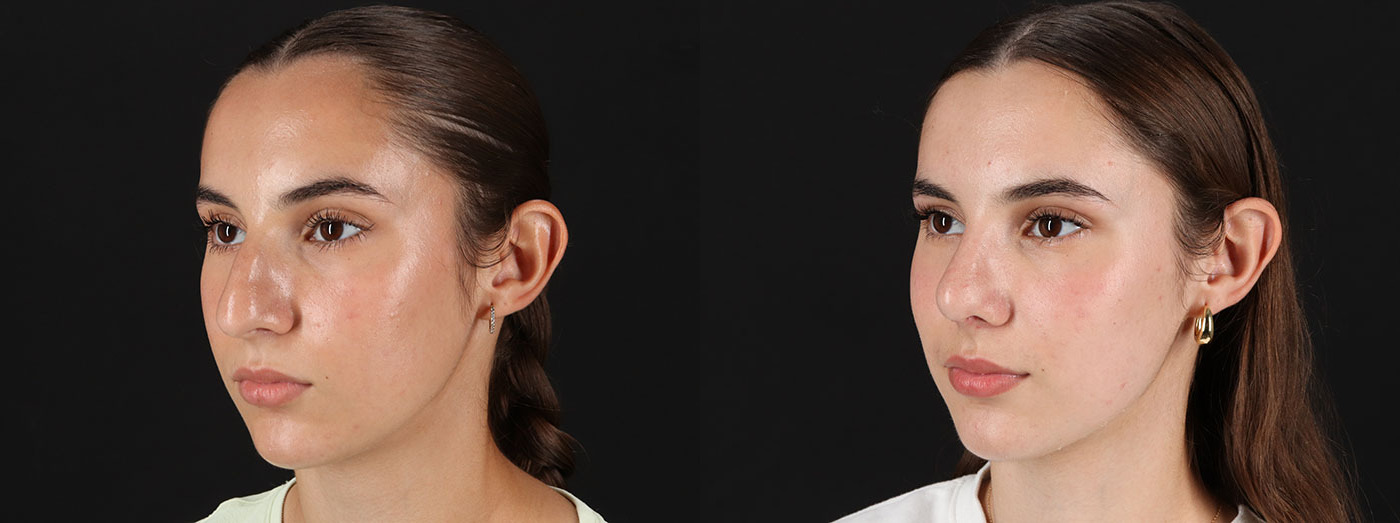 Rhinoplasty Before and After Photo by Baylan Plastic Surgery in Houston TX Rhinoplasty Before and After Photo by Baylan Plastic Surgery in Houston TX