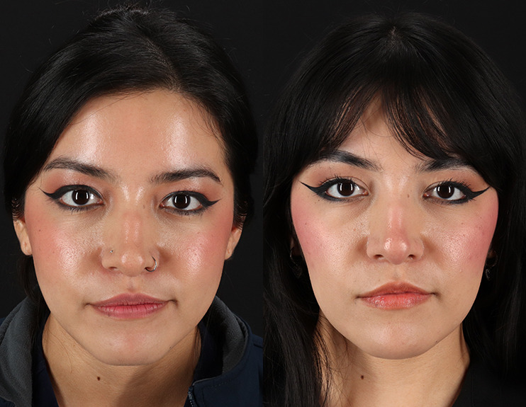 Botox Before and After Photo by Baylan Plastic Surgery in Houston TX