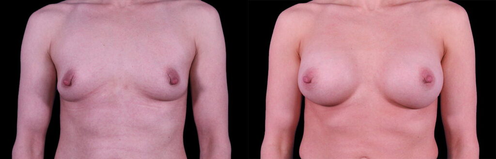 Breast Augmentation with Implants Before and After Photo by Baylan Plastic Surgery in Houston TX