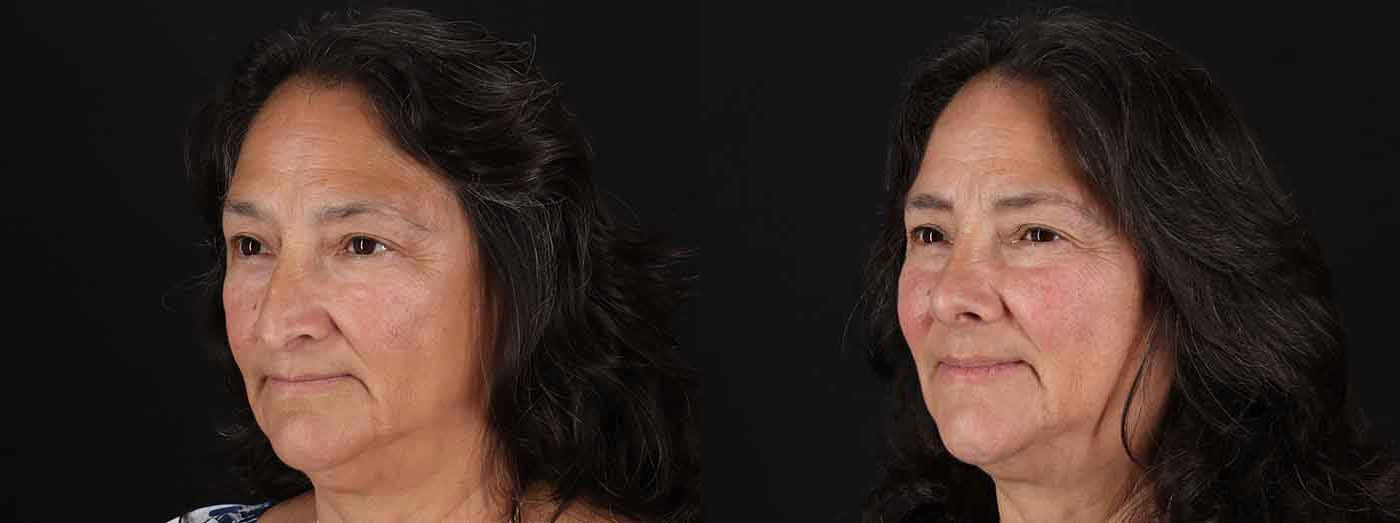 rhinoplasty-before-and-after-patient-photo2 rhinoplasty before and after patient photo 2