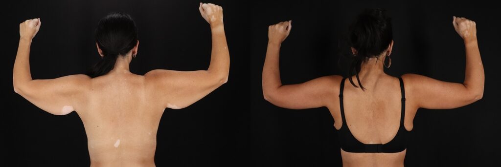 Brachioplasty before and after photo by Baylan Plastic Surgery in Houston TX