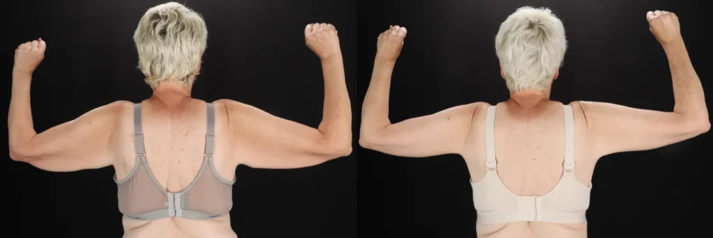 Arm Lift Before and After Photo by Baylan Plastic Surgery in Houston TX