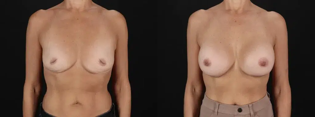 Breast Augmentation with Implants + Inverted Nipple Correction Before and After Photo by Baylan Plastic Surgery in Houston TX