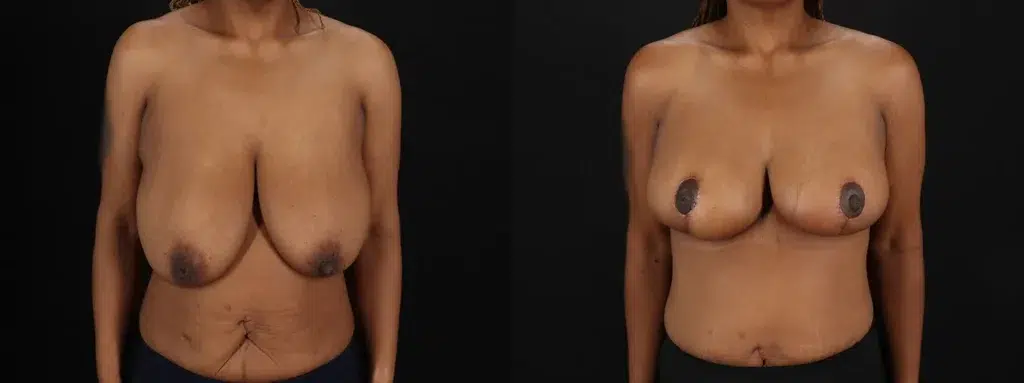 Breast Reduction + Breast Lift Before and After Photo by Baylan Plastic Surgery in Houston TX
