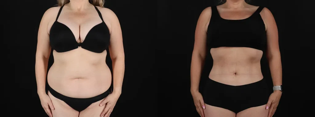Liposuction Before and After Photo by Baylan Plastic Surgery in Houston TX