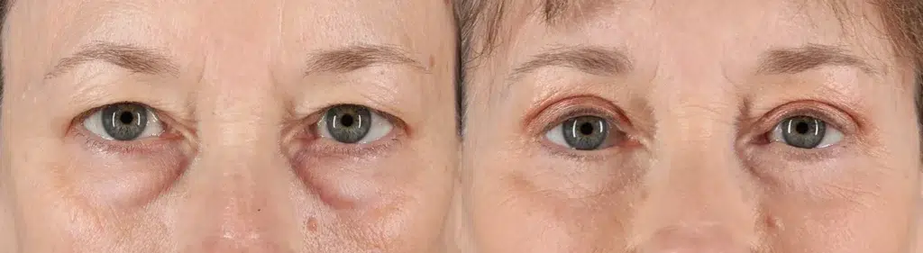 Quad Blepharoplasty Before and After Photo by Baylan Plastic Surgery in Houston TX