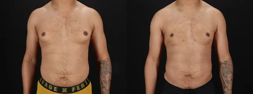 Gynecomastia with Liposuction Before and After Photo by Baylan Plastic Surgery in Houston TX